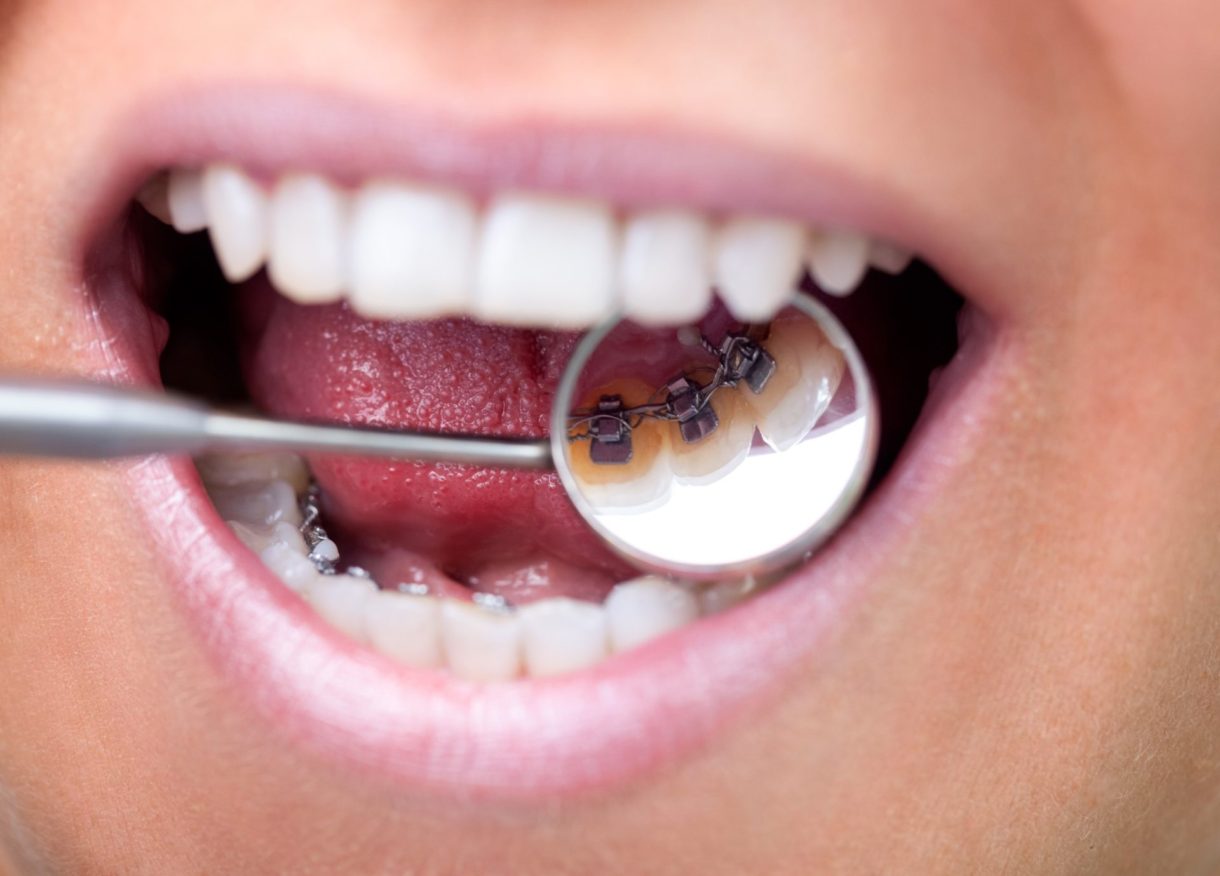 矯正治療の「装置」にはどのようなものがあるの？｜歯列矯正歯科の総合 